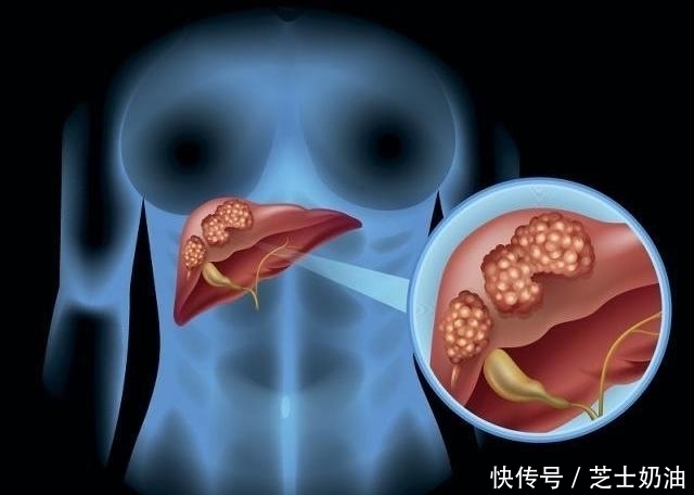 吃药|最伤肝的事,原来根本不是吃药,而是“它”,很多人天天都在做!