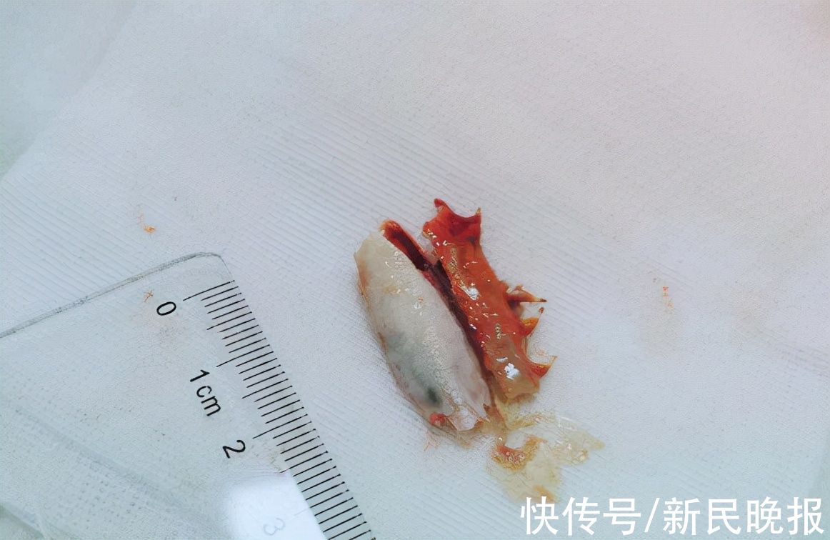 支气管镜|梭子蟹配酒,销魂!但醉酒后蟹腿卡气道,苦了