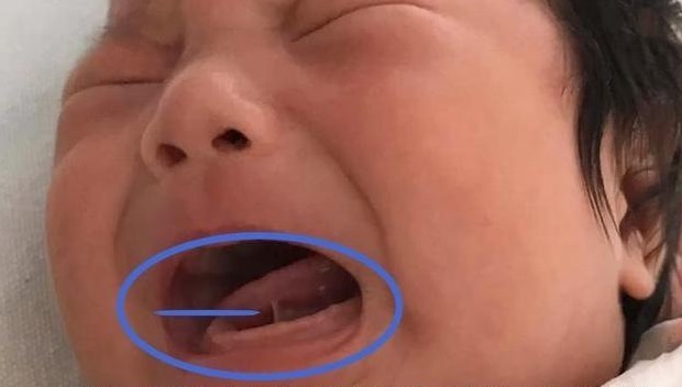 睫毛|宝宝1岁还不会说话,爷爷怀疑没剪舌根,医生回去吧治不了