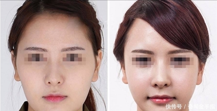 脸上打“玻尿酸”的女孩子之后怎样了?听美容专家一说全明白