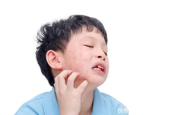 1岁宝宝染上荨麻疹怎么办百新哈,妈妈们的首选宝宝用很放心