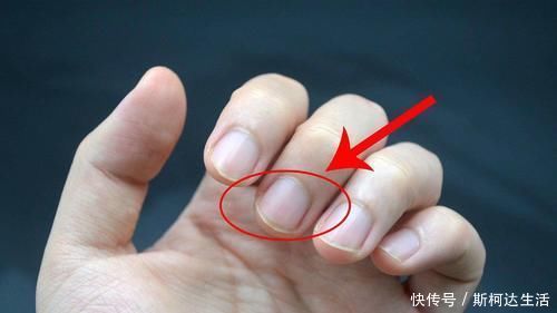 月牙|指甲是人体健康的“晴雨表”,若有这3个表现,或与健康密切相关