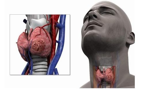 结节|女孩被闺蜜一个月29次“826”，确诊甲状腺癌，医生叹息：果真是好姐妹