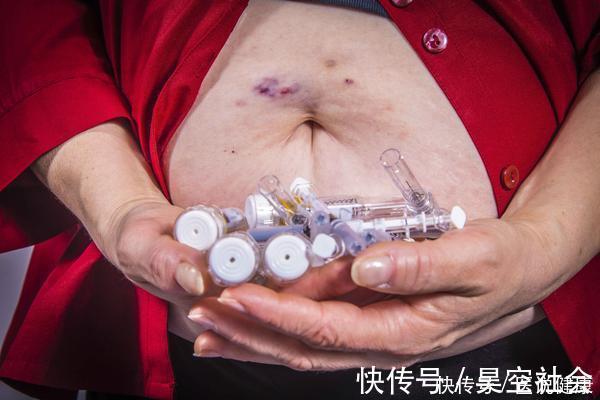 症状|糖尿病来临前,往往有这3种信号,若你全占,需重视