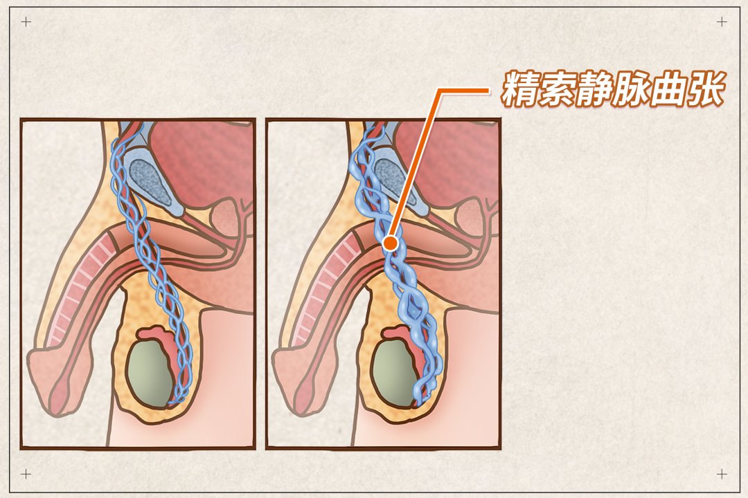 雄激素|一种患病率高达20%，可导致男性不育，却大多无需处理的疾病