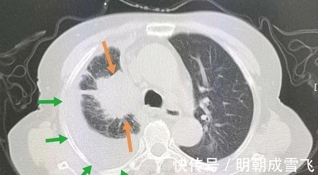 病人|癌症晚期病人差异这么大？有人可以5年以上，有人只有9天寿命？