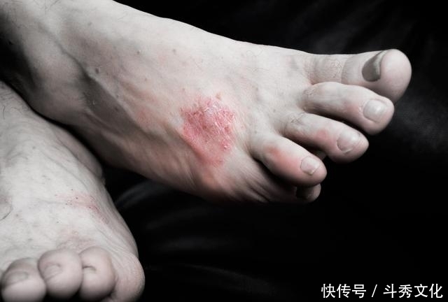 利于人体|这3类东西,一定少碰,可防皮炎反复