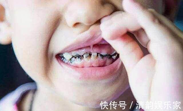 牙齿|小宝宝15颗烂牙全拔掉,根源还在家长身上,别让娃抱着奶瓶睡了