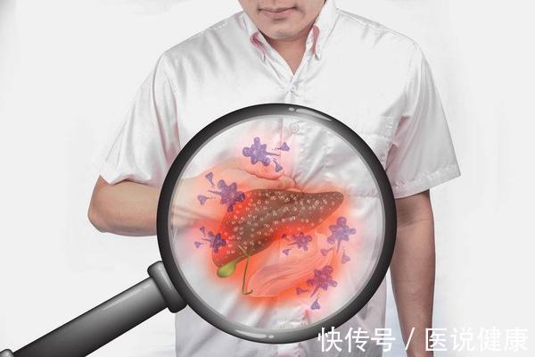 门静脉高压|肝不好,多留意身体上的表现,出现这5种情况,或是肝衰竭的信号