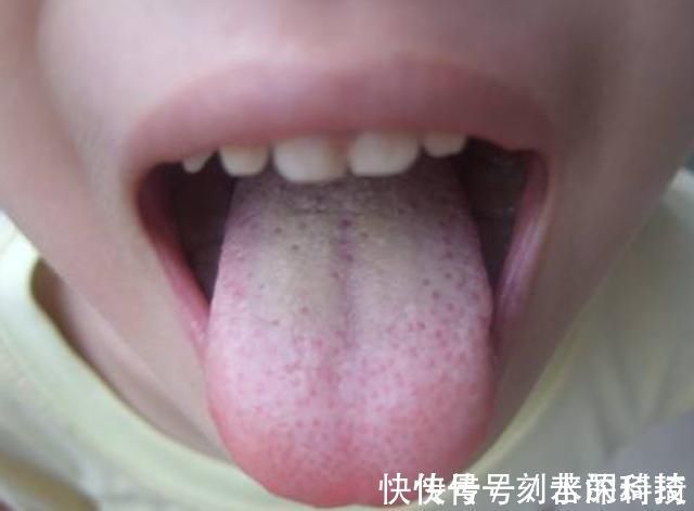 十孩九积|双胞胎长期积食不在意,拖成“疳积”,儿科医生:家长无知造成的