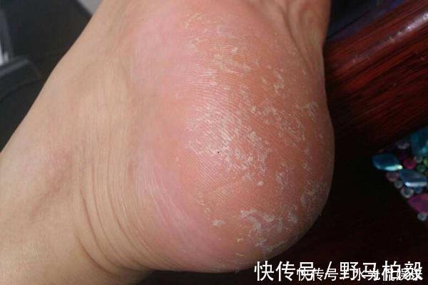 健康|人的双脚是健康“警报器”，有9种变化，说明你身体出问题了