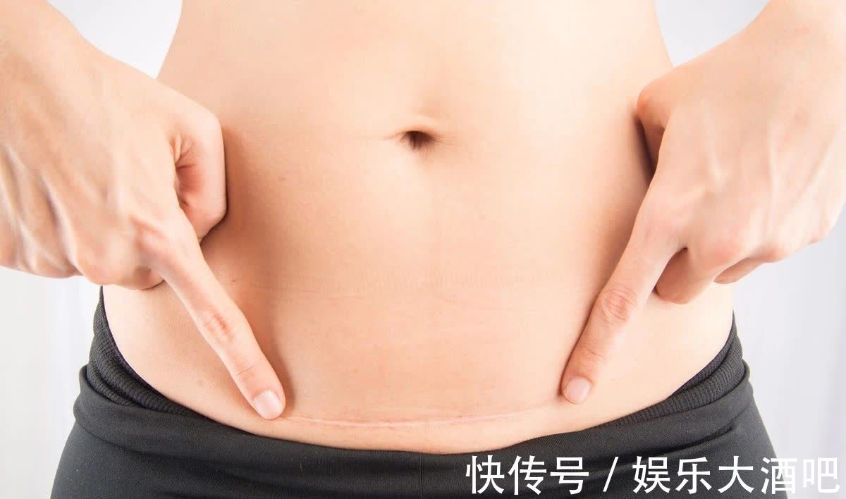 小枫|剖腹产的女性，产后若不想疤痕增生，这三件事一定不要做，得忍住