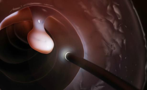 老戴|有三种息肉最好及时切除,拖延太久就会变成恶性肿瘤!你清楚吗?