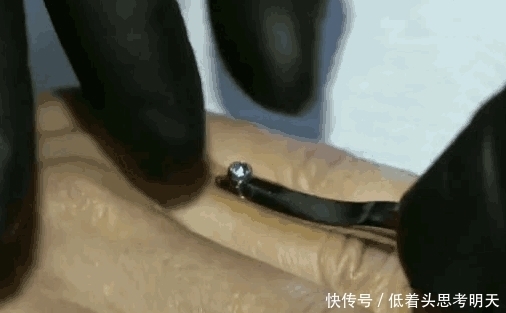 钻石|情侣为证明真爱,竟把钻石用电钻镶在手指上,医生表示:愚昧无知
