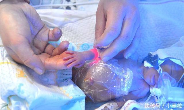手术|孕妇产下五胞胎，最小的宝宝只有鸡蛋大，网友：她超额完成任务