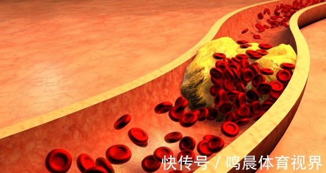 血压偏高|比油盐还伤血管,世卫组织已呼吁停止食用,血压偏高尽量注意