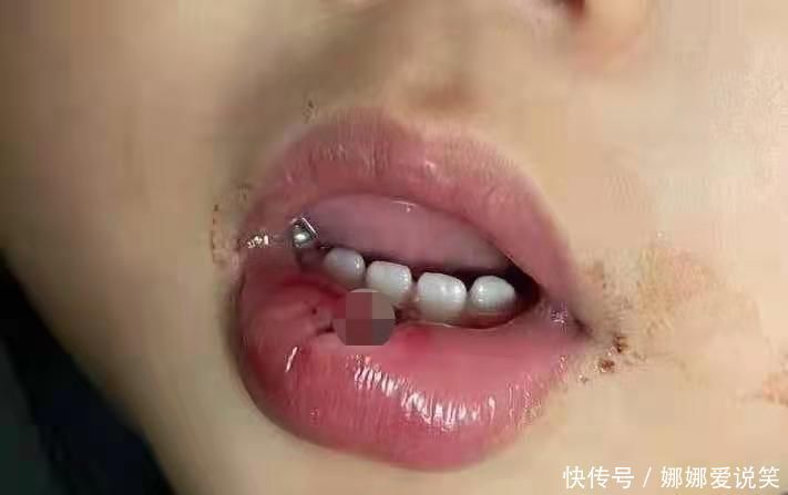 小宝|孩子误吞硬币、意外受伤该怎么办？儿科医生提醒：这样做才正确