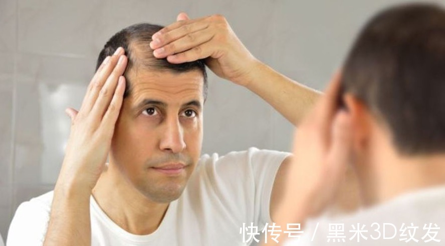 脱发者 黑米3D纹发:关于植发的一些事实《5-8》