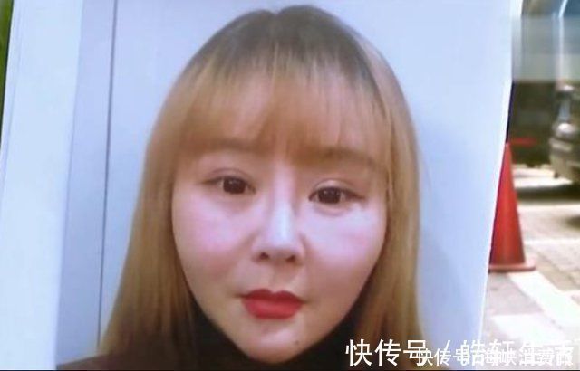 女子|女子花1万3做面部埋线,术后变成“大饼脸”,美颜都救不回来