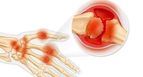 关节炎|不论男女,手上若有这种表现,小心类风湿性关节炎“找上门”!