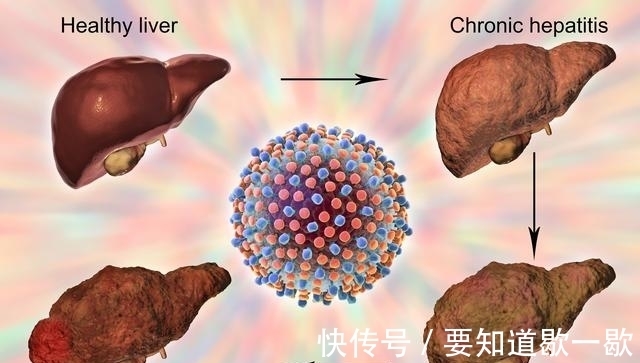 肝硬化|肝硬化不治疗会引起肝衰竭甚至肝癌,一定要做好4点来预防!