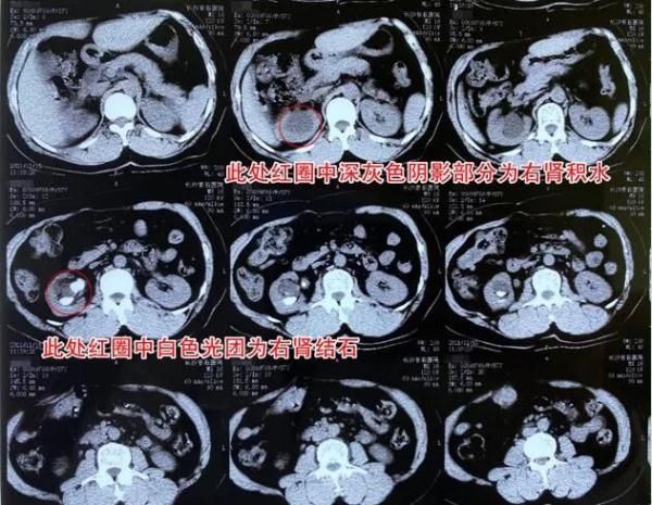 泌尿系统疾病|女子常年腰酸腰胀以为劳累导致，入院检查才得知……