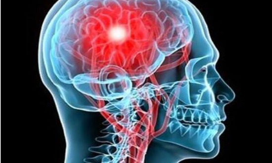缺血性脑卒中|世界卒中日你需要对脑中风引起重视!它正悄悄来临,2点可预防