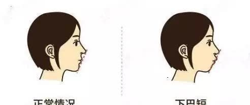 黄金期|孩子牙齿矫正,必须要12岁以后吗?你是否错过了孩子的矫正黄金期