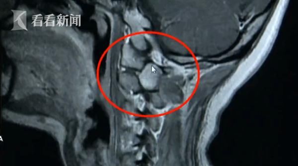 The woman's neck was sore and thought it was cervical spondylosis, but she was shocked...