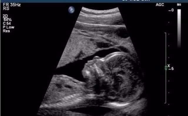 吸烟|孕期胎儿频繁好动，孕妈以为宝宝很健康，产检后医生建议不能留！