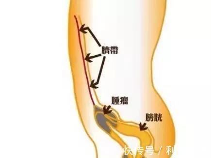 腺癌|明明感觉不到疼,为什么还一直尿血呢?一查竟是脐尿管腺癌在惹祸