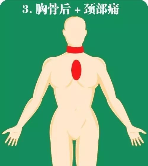 心梗|急性心梗10个常见疼痛部位及图解！