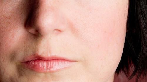 危险三角区的痘痘千万不能挤!有人挤了