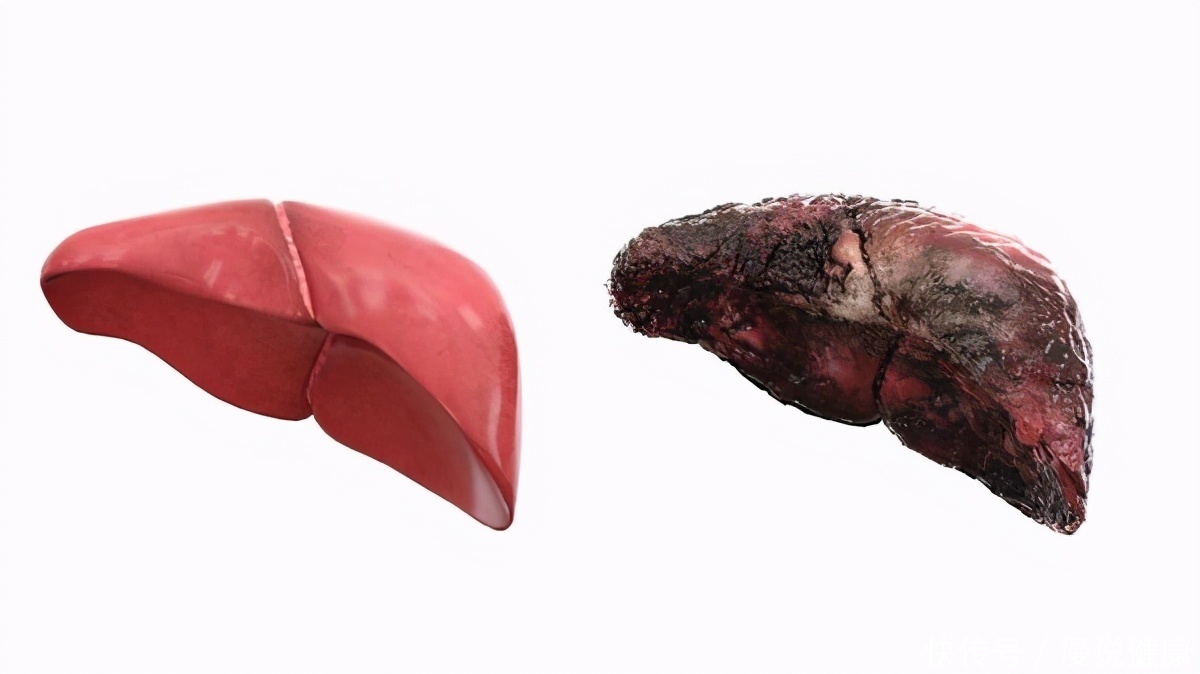 癌细胞|肝癌并非毫无征兆,身体若有“2黑2臭”,医生建议你早点检查肝脏