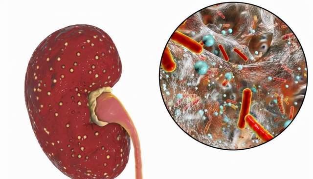 肾脏健康|尿毒症比癌症折磨人，让肾走向衰竭的4个“源头”，要及时制止