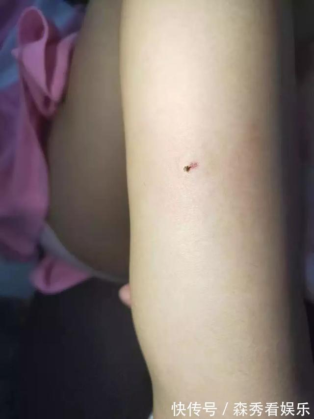 丧命|3岁女孩因为一根刺险丧命!妈妈的这个做法救了孩子!