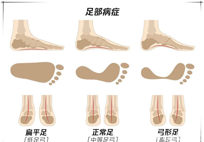 脚底|家长带孩子“泡脚”,或会耽误娃的脚部发育,现在改还来得及