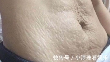 孕期|怀孕后害怕身上长妊娠纹,注意这些要点,让妊娠纹离得远远的