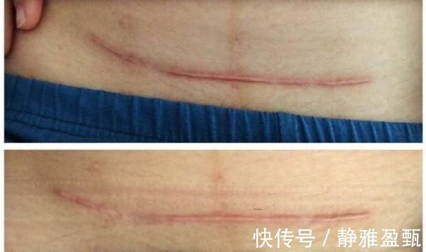 产妇|宝妈剖腹产后,伤口看着都疼,没俩个人扶连起床都难