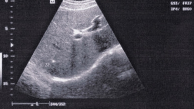 乙肝|身上长出“小红点”,医院查出肝硬化,2类人要注意