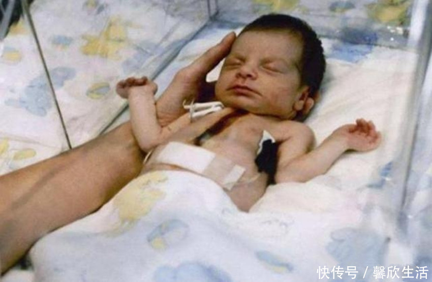 女婴|还记得36年前移植“狒狒”心脏的女婴吗手术虽成功，但结局惋惜