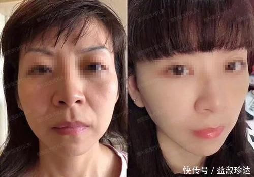 年纪|聊一聊除了拉皮手术,微创小切口提升怎么样?多大年纪适合做?