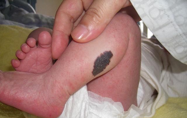 胎记|18岁女孩因为脸上的胎记,选择结束生命,胎记到底是怎么形成的