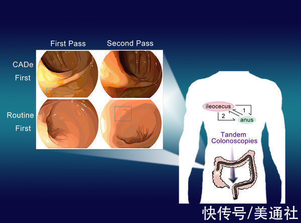 endoscreener|Wision A.I.：全球首个医疗AI领域独立外部随机对照试验发表