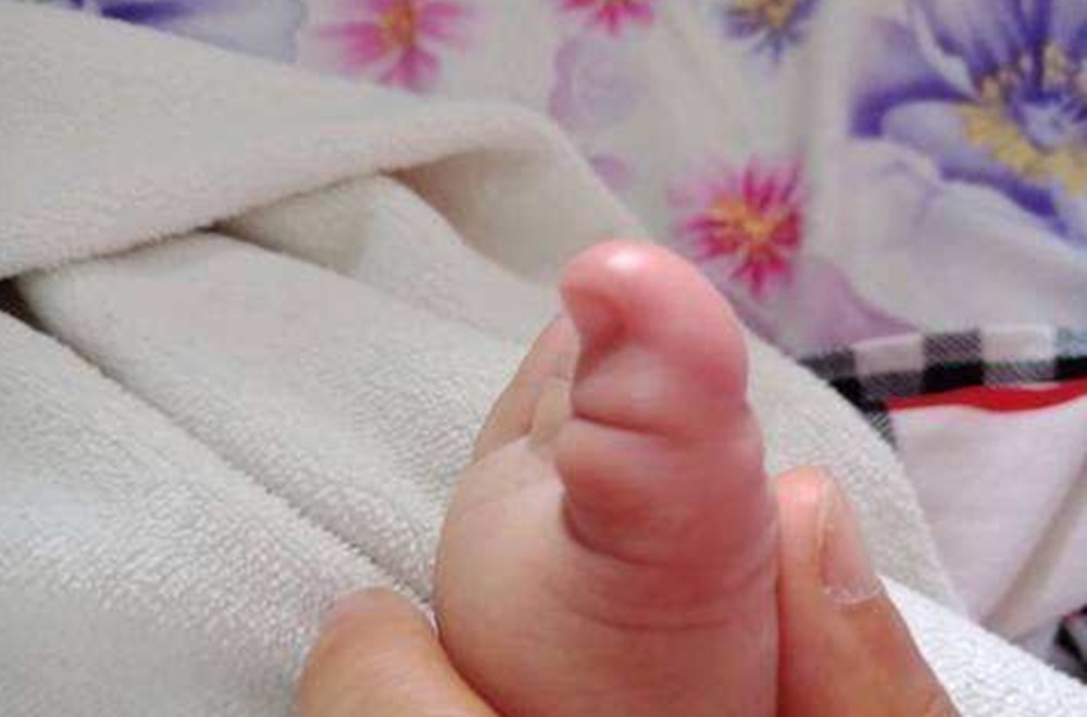 鞋子|4岁宝宝双脚变形,只因长时间穿这种鞋子,父母别不当回事