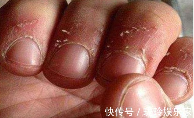 营养物质|孩子手上经常出现“倒刺”,家长着急,可能是3个原因引起的