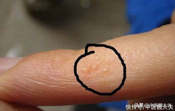 小水泡|痒!痒!痒!手脚上长了透明的“小水泡”,是上火了吗?