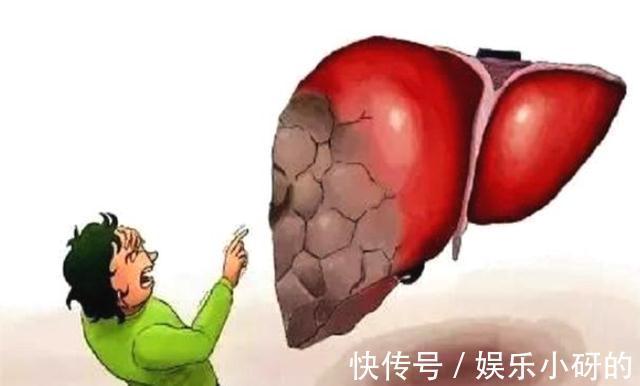 过敏|身体两处“发痒”,别误以为是过敏,有可能是肝病的“报警器”