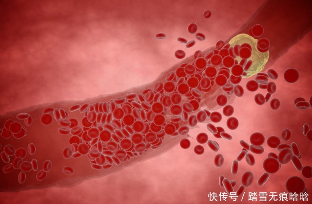  没事|血栓的“清洁工”发现了，不是醋，没事吃一点，血栓“躲着走”