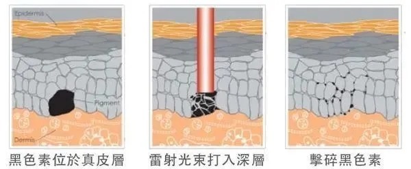 去雀斑要趁早？选光子还是激光？丨科普篇